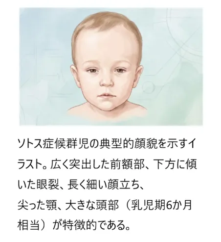 ソトス症候群の典型的顔貌