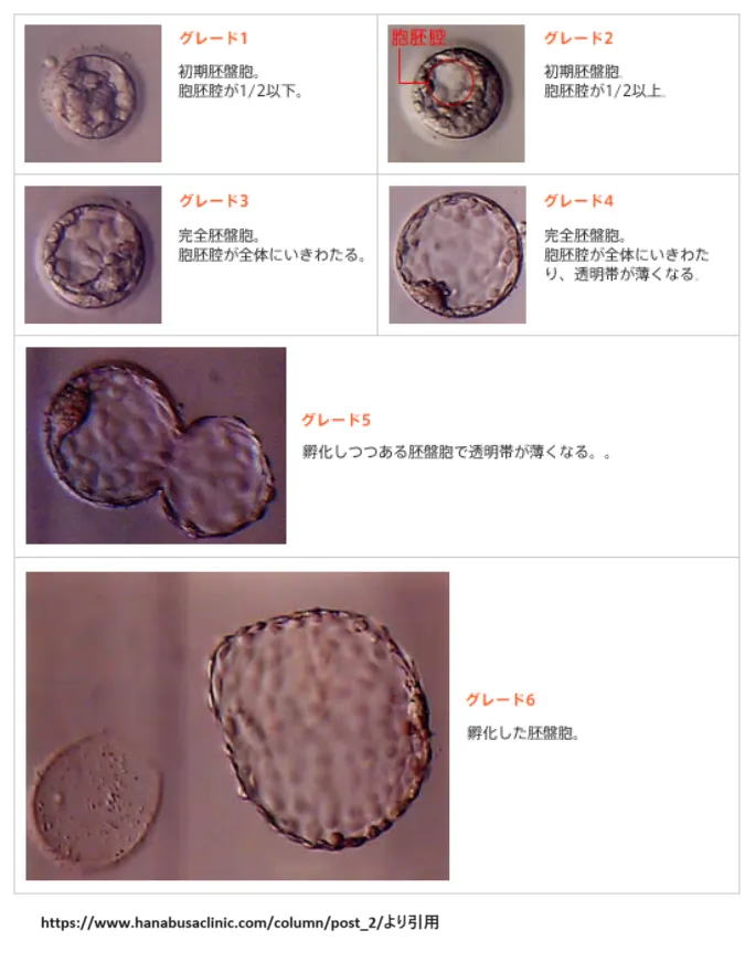 胚盤胞のグレード分類