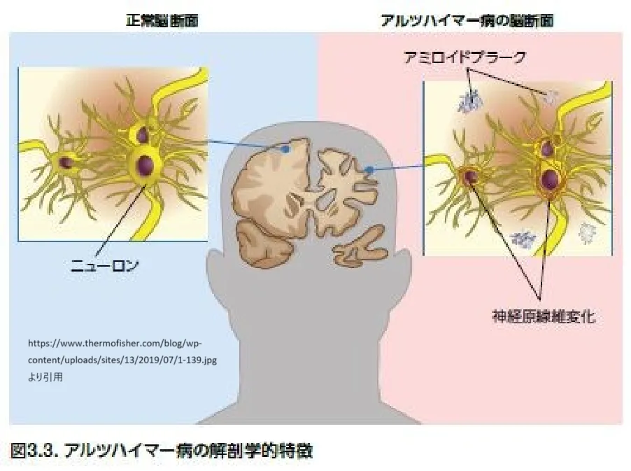 アルツハイマー病の神経損傷