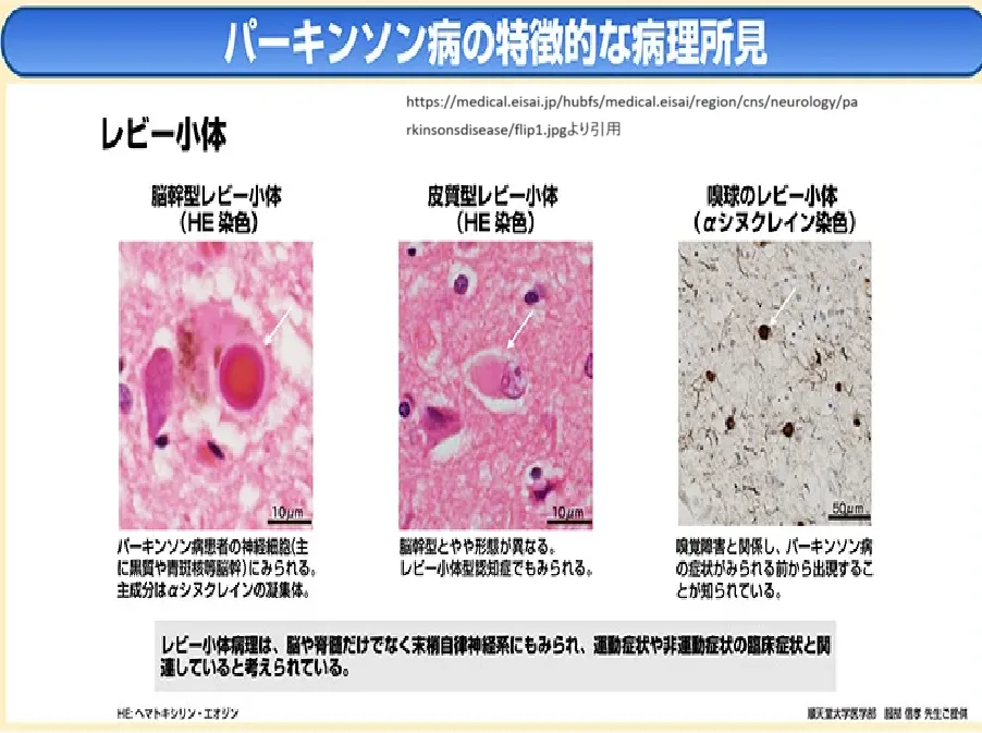 パーキンソン病の病理所見
