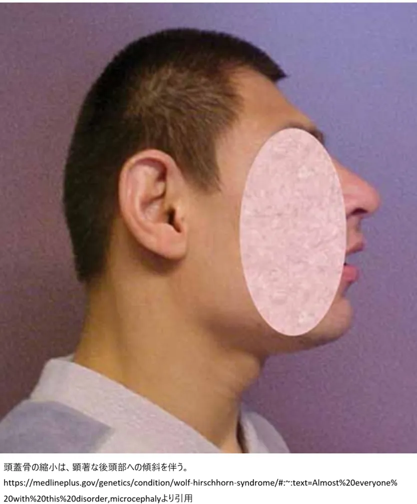 Wolf-Hirschhorn syndromeの顔貌