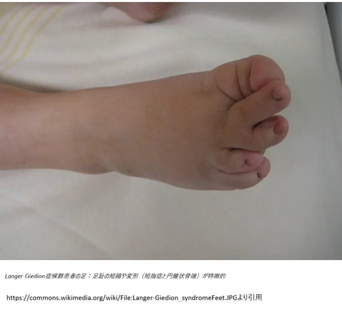 Langer-Giedion症候群患者の足