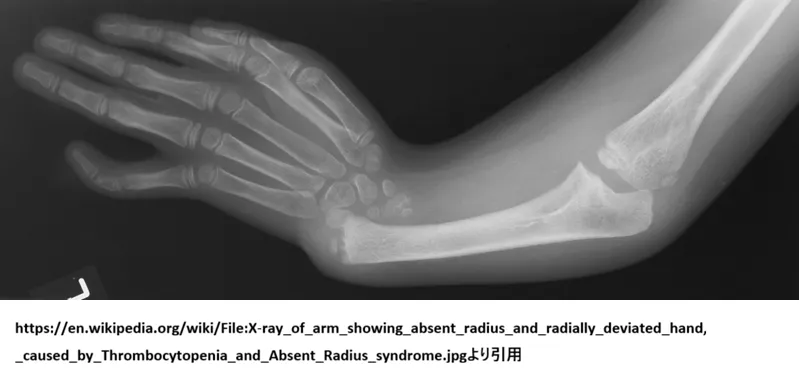 TAR症候群（血小板減少・橈骨欠損症候群）の前腕X線画像。橈骨が欠損し、尺骨のみが存在するが、母指（親指）は保たれている典型的所見。