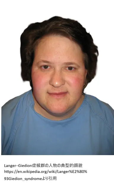 Langer–Giedion症候群の典型的顔貌