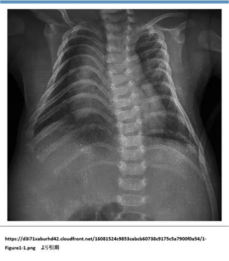 コートハンガー肋骨のレントゲン画像