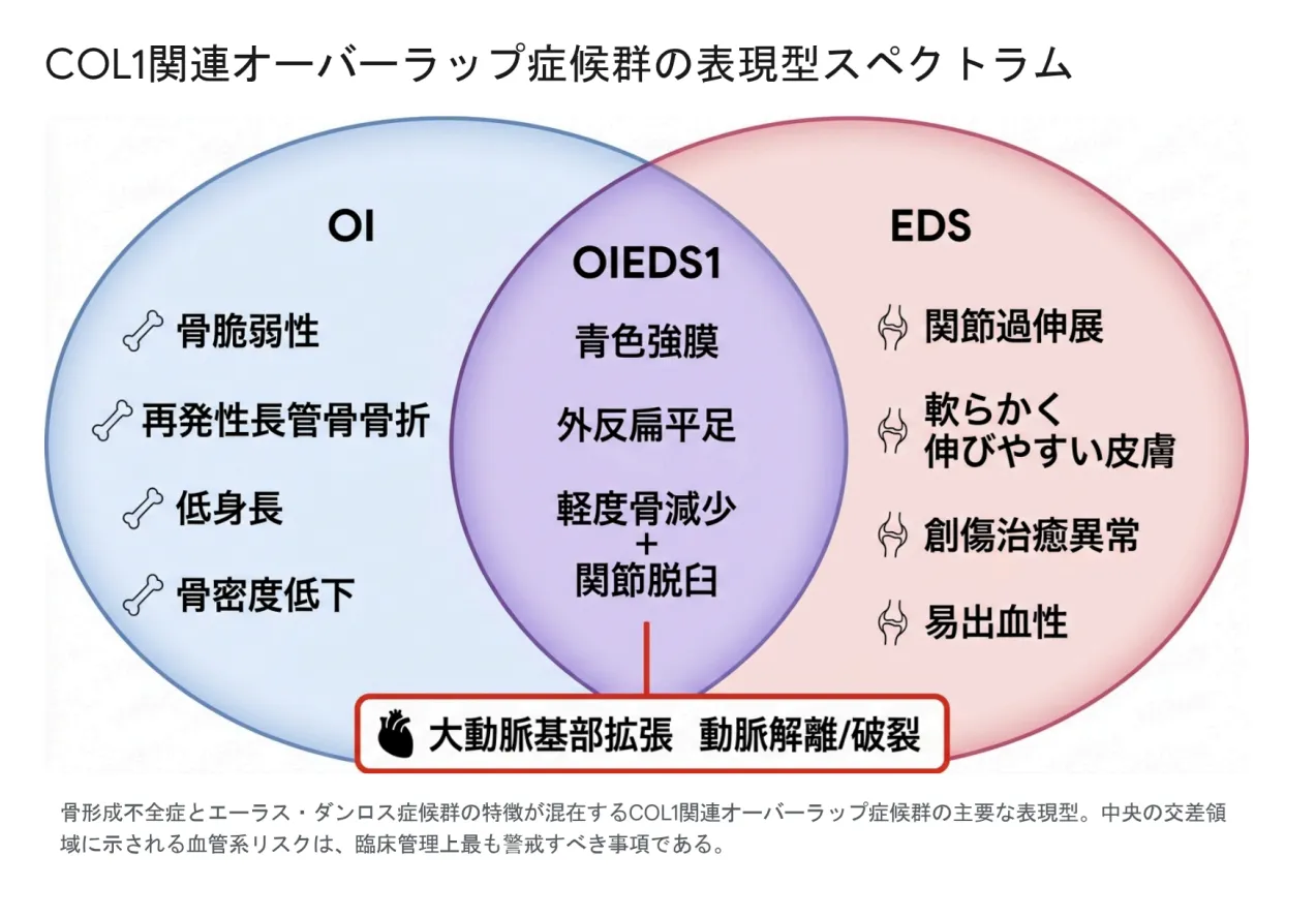 COL1関連オーバーラップ症候群(C1ROD)の表現型スペクトラムを示すベン図。左にOI(骨脆弱性・再発性骨折・低身長・骨密度低下)、右にEDS(関節過伸展・皮膚の過伸展・創傷治癒異常・易出血性)、中央の重なりにOIEDS1(青色強膜・外反扁平足・軽度骨減少+関節脱臼)、最下部に最も警戒すべき心血管リスク(大動脈基部拡張・動脈解離/破裂)を配置。