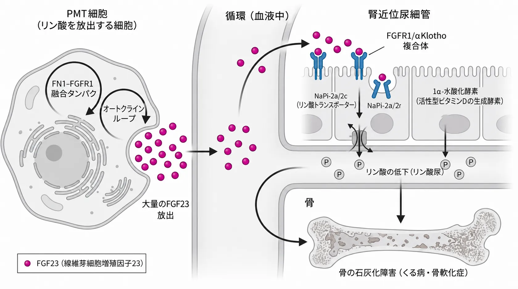 腫瘍性骨軟化症の発症メカニズムを示す模式図。左のPMT細胞内でFN1-FGFR1融合とオートクラインループによりFGF23が大量に作られて放出され、血流を通って腎近位尿細管に到達。FGFR1/α-Klotho複合体に結合してリン酸輸送体NaPi-2aと1α-水酸化酵素を抑制し、リン酸尿を起こして骨の石灰化を障害する流れを図示している。