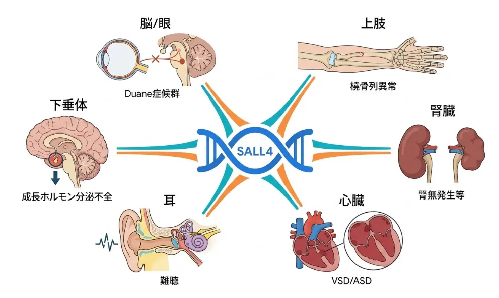 SALL4遺伝子を中心に、機能低下によって影響を受ける6つの臓器・部位を放射状に示した模式図。脳・眼ではDuane症候群(眼球運動異常)、上肢では橈骨列異常、腎臓では腎無発生など、心臓ではVSD/ASD(心室・心房中隔欠損)、耳では難聴、下垂体では成長ホルモン分泌不全が起こることを表す。SALL4が発生段階で全身の器官形成に関わる転写因子であることを示している。