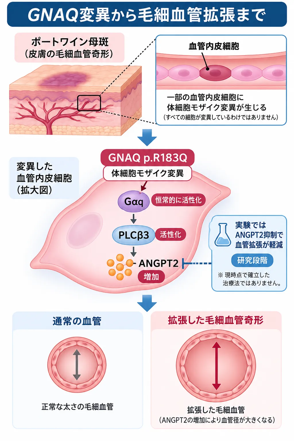 ポートワイン母斑では、一部の血管内皮細胞に生じたGNAQ p.R183Q体細胞モザイク変異によりGαqシグナルが持続的に活性化し、ANGPT2増加などを介して毛細血管の拡張につながる発症機序を示した模式図