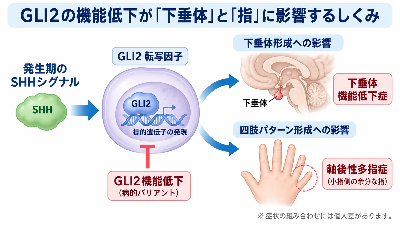 GLI2の機能低下によってSHHシグナルを介する発生期の遺伝子発現が障害され、下垂体形成異常による下垂体機能低下症と、四肢パターン形成異常による軸後性多指症につながる仕組みを示す模式図