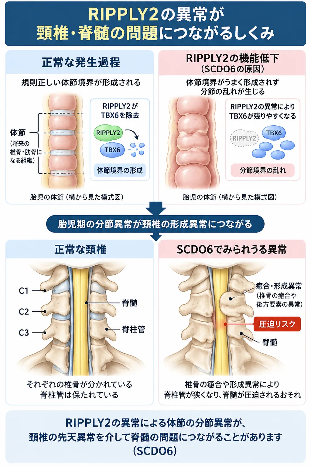 RIPPLY2機能低下によりTBX6の除去が不十分となって体節境界が乱れ、頸椎の癒合・形成異常や脊柱管狭窄、脊髄圧迫につながるSCDO6の発症機序を正常と比較した模式図