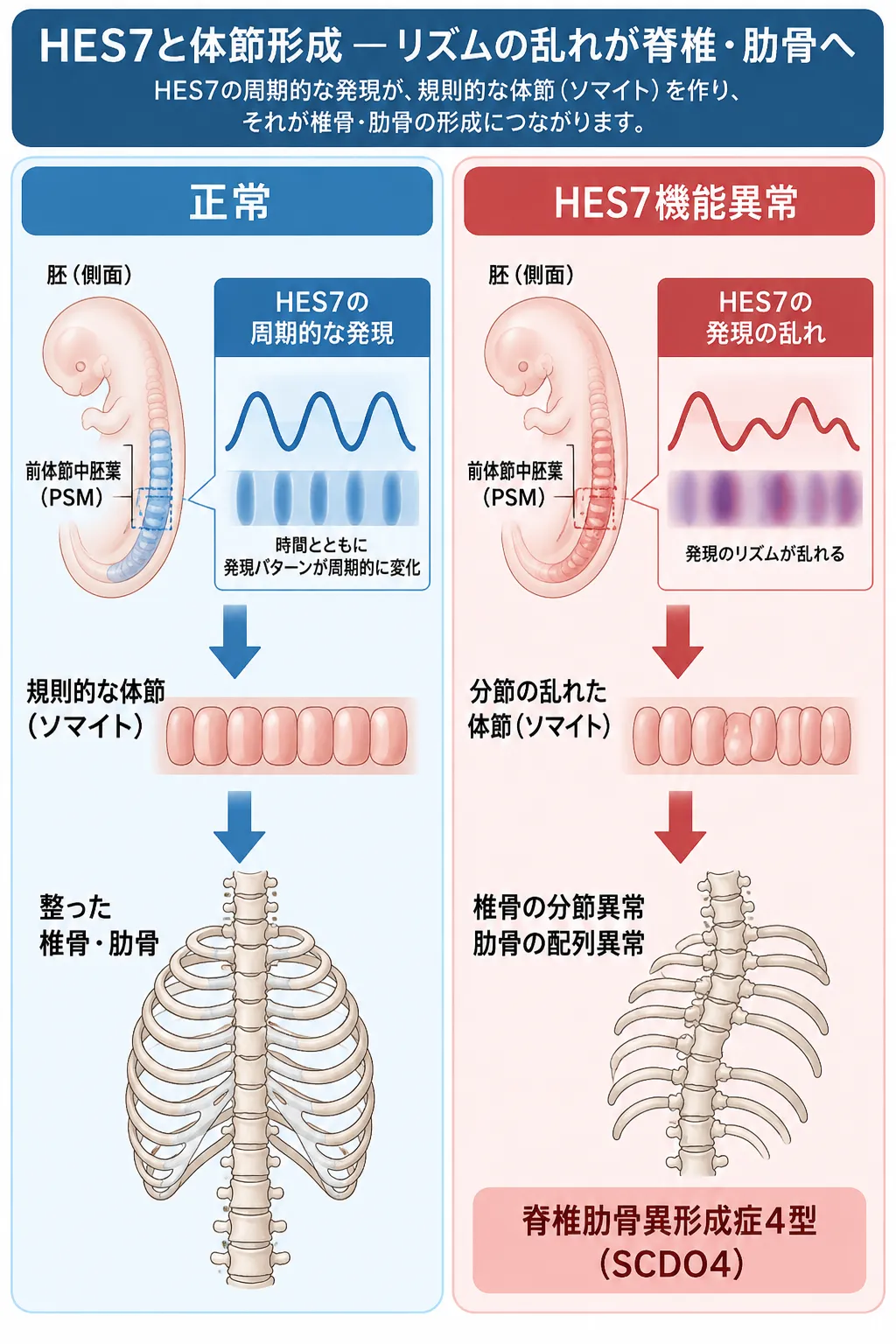 HES7の周期的な発現によって規則的な体節が形成され、正常な椎骨・肋骨につながる過程と、HES7機能異常による体節形成の乱れから椎骨・肋骨の分節異常を伴う脊椎肋骨異形成症4型（SCDO4）に至る仕組みを比較した模式図