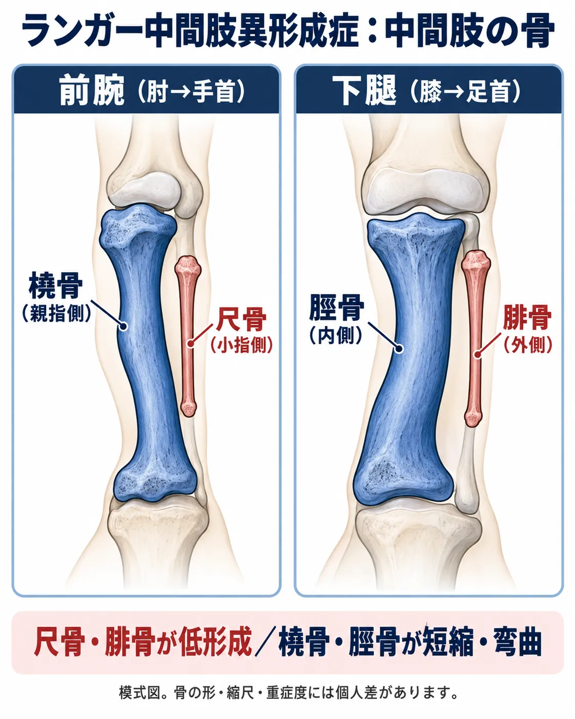 ランガー中間肢異形成症における前腕と下腿の骨の模式図。尺骨と腓骨の低形成、橈骨と脛骨の短縮・弯曲を示す