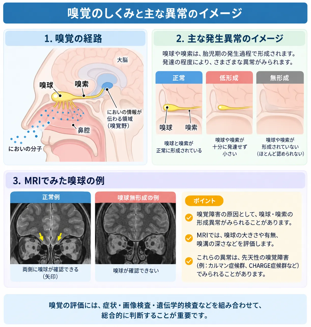 嗅覚のしくみと嗅球低形成・嗅球無形成を示す模式図。鼻腔から嗅球・嗅索へにおいの情報が伝わる経路、正常・低形成・無形成の違い、MRIでの嗅球評価を示している。
