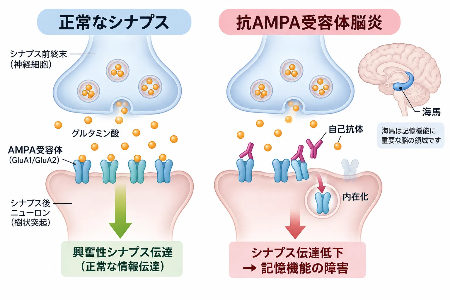 正常なシナプスと抗AMPA受容体脳炎を比較し、自己抗体がGluA1・GluA2を含むAMPA受容体に結合して受容体の内在化・減少を引き起こし、興奮性シナプス伝達が低下して記憶機能が障害される仕組みを示す模式図