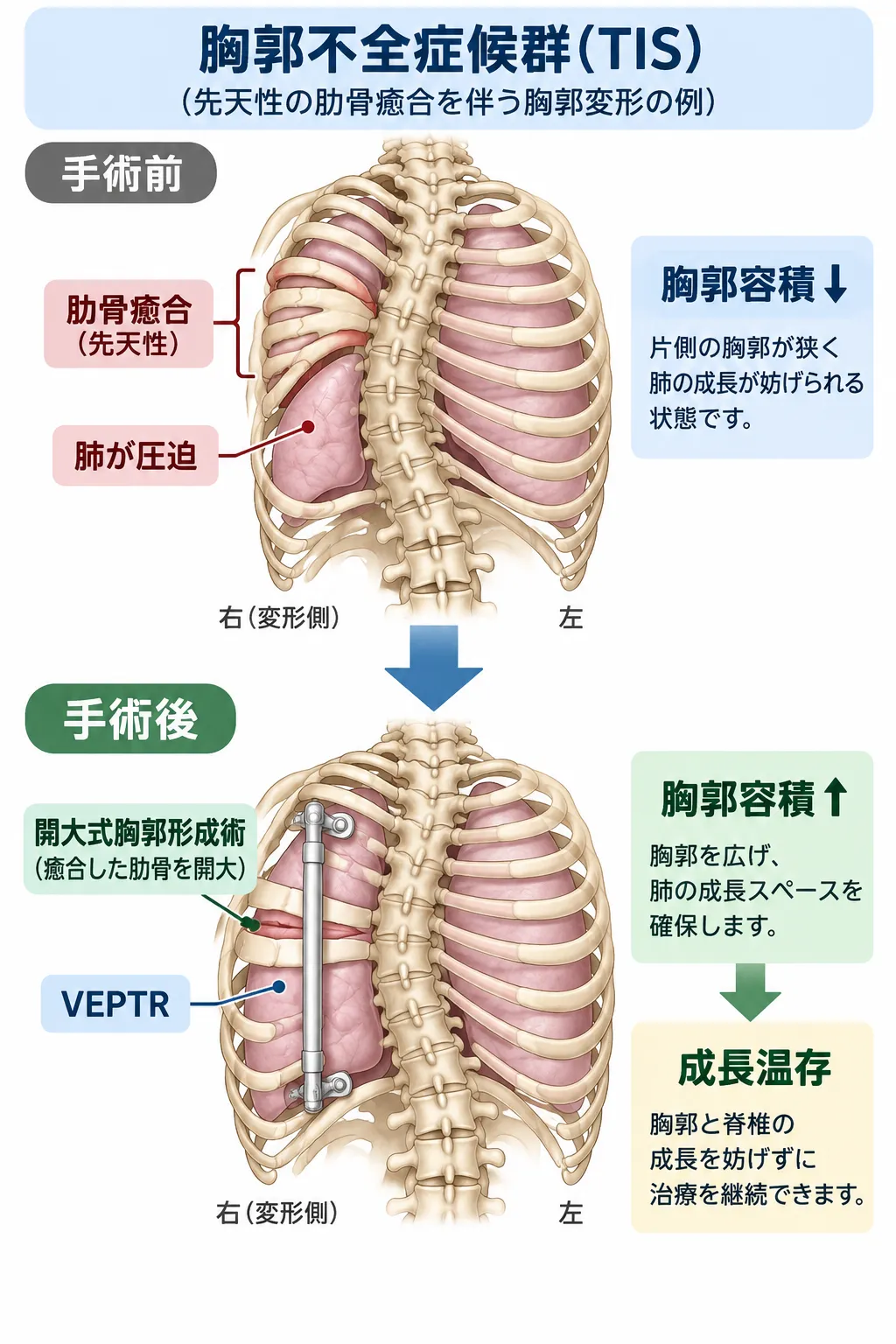 先天性の肋骨癒合を伴う胸郭不全症候群（TIS）で、狭い胸郭により肺の成長が妨げられる状態と、開大式胸郭形成術およびVEPTRによって胸郭を拡大し肺の成長スペースを確保する仕組みを比較した模式図