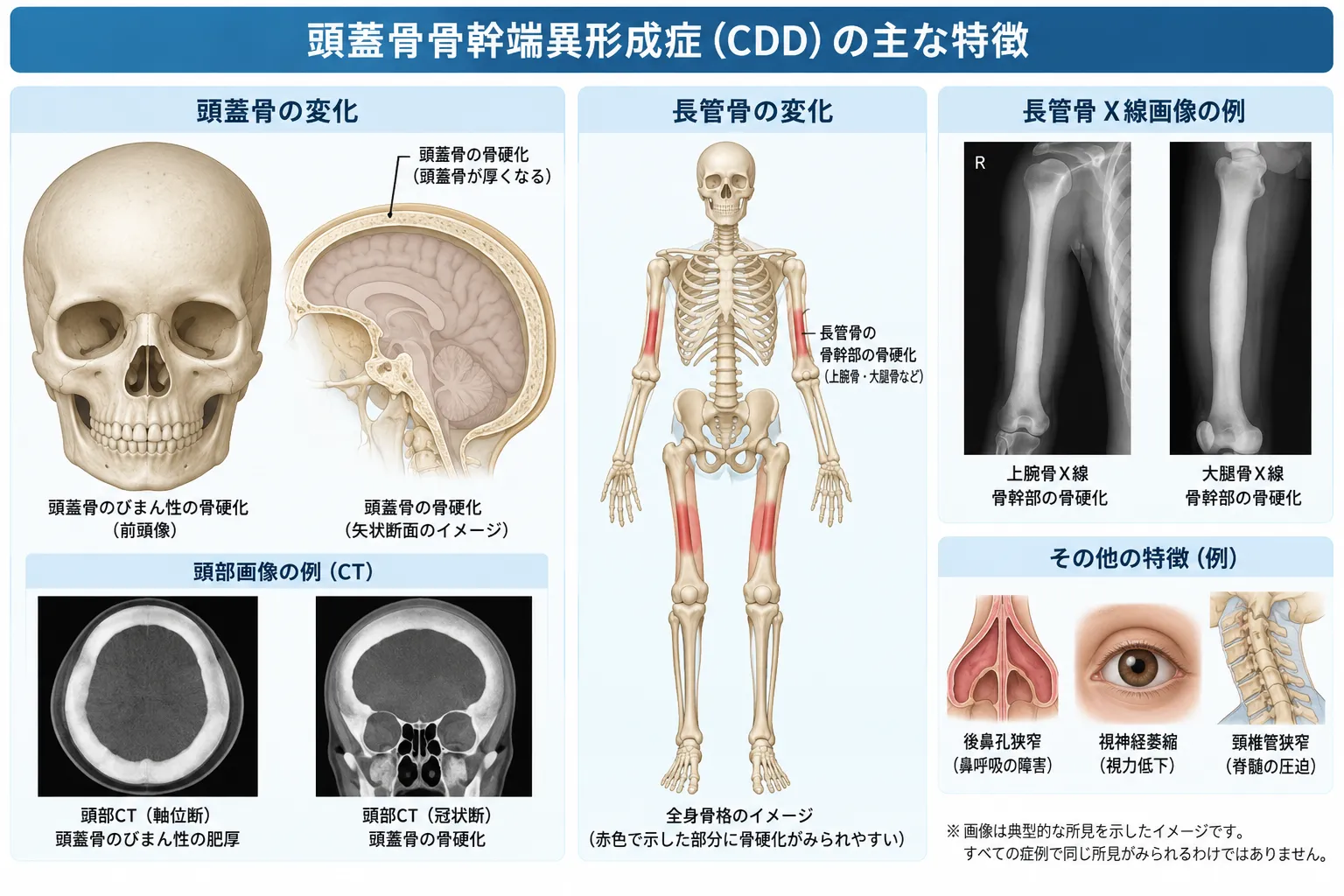 頭蓋骨幹異形成症(CDD)における頭蓋骨の過形成・骨硬化、長管骨骨幹部の変化、後鼻孔狭窄、視神経障害、頸椎管狭窄を示す医学イラスト
