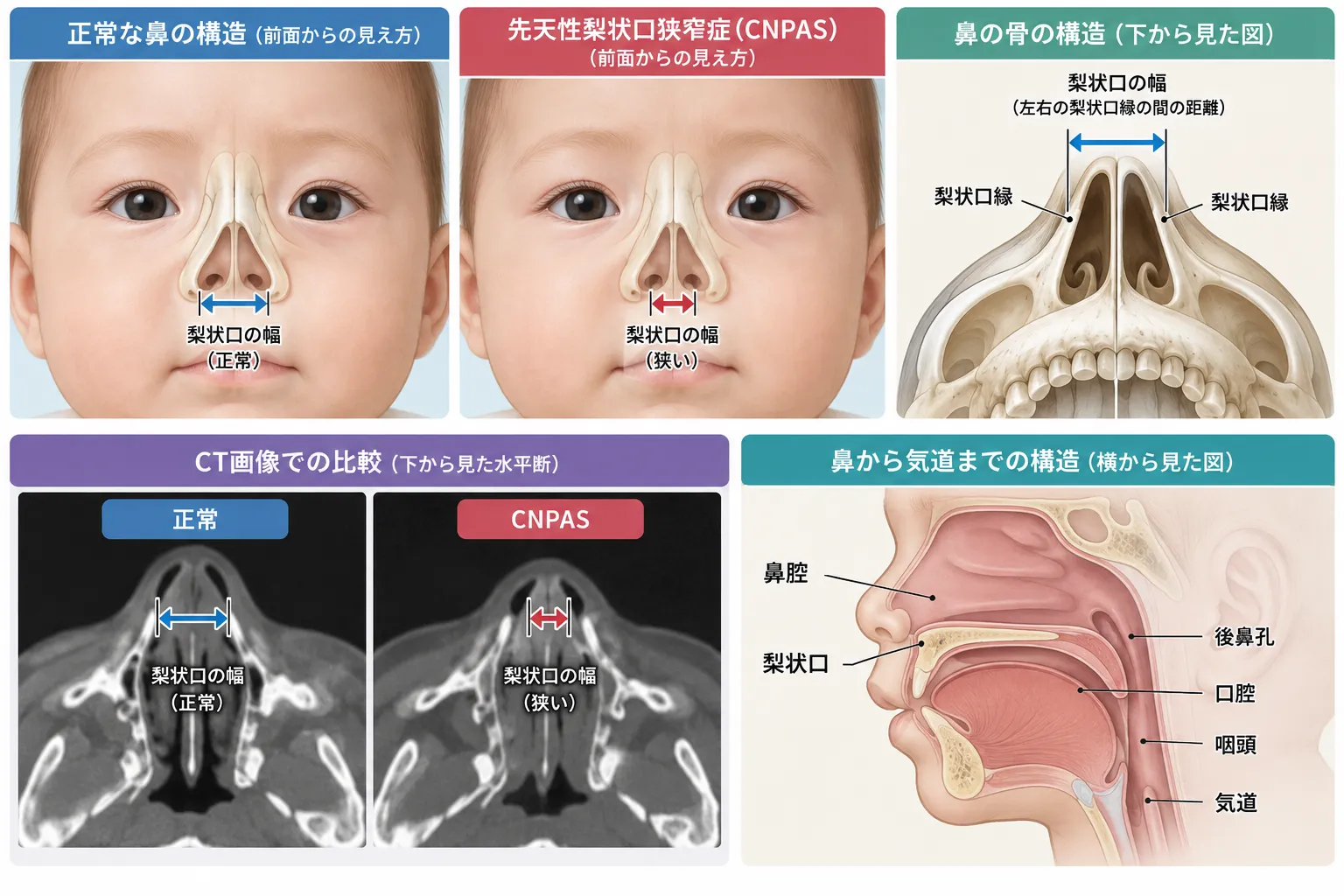 先天性梨状口狭窄症（CNPAS）の鼻腔構造を示す医学イラスト。正常とCNPASの梨状口の幅、CT横断像、鼻腔・後鼻孔・口腔・咽頭・気道の位置関係を比較