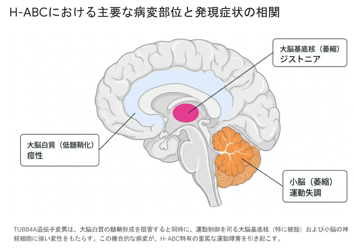 H-ABCの脳の矢状断面図。低髄鞘化した大脳白質は痙性、萎縮した大脳基底核（被殻）はジストニア、萎縮した小脳は運動失調と対応し、TUBB4A遺伝子変異による3部位の複合的な病変を示す図