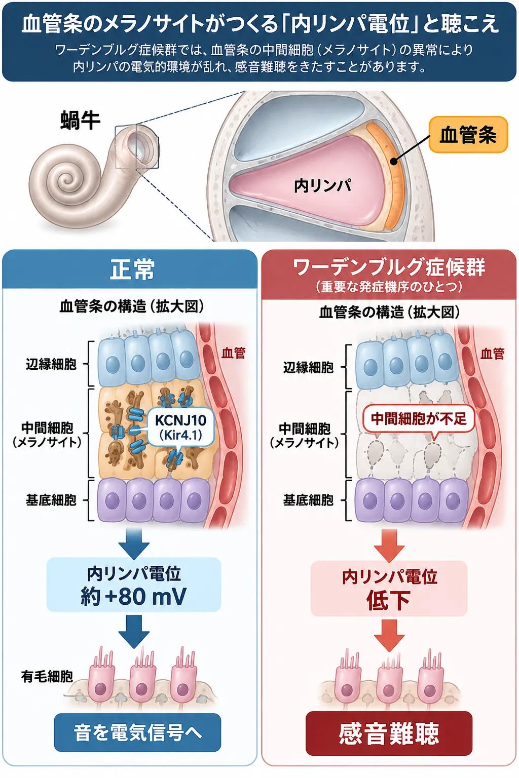 ワーデンブルグ症候群で血管条の中間細胞(メラノサイト)が不足するとKCNJ10を介した内リンパ電位の維持が障害され、感音難聴につながる発症機序を正常と比較した模式図