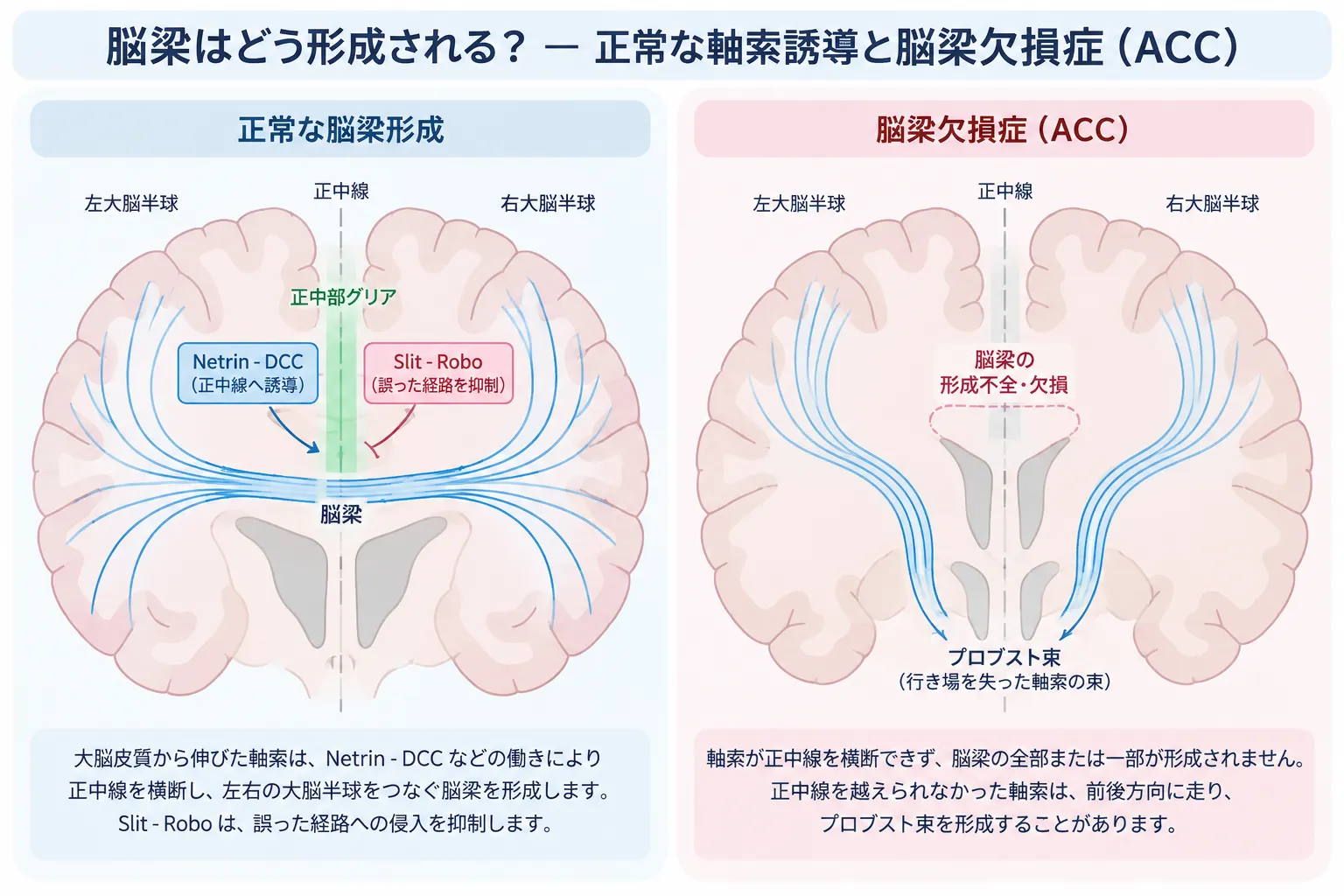 正常な脳梁形成と脳梁欠損症(ACC)を比較した模式図。正常ではNetrin-DCCとSlit-Roboによる軸索誘導により大脳皮質から伸びた軸索が正中線を横断して脳梁を形成する。ACCでは軸索が正中線を横断できず、脳梁の全部または一部が形成されず、正中線に沿って走るプロブスト束を形成することがある。