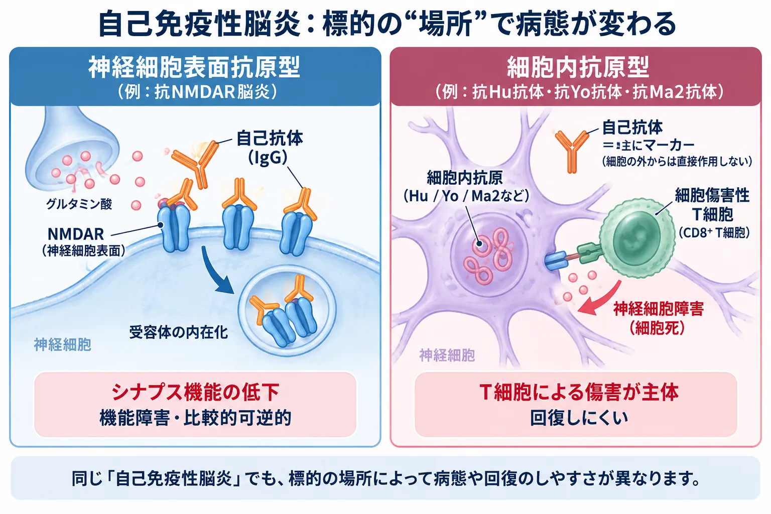 自己免疫性脳炎における神経細胞表面抗原型と細胞内抗原型の違い。抗NMDAR脳炎では自己抗体によるNMDA受容体の内在化とシナプス機能低下、抗Hu・Yo・Ma2抗体関連では細胞傷害性T細胞による神経細胞障害が主体となる病態を比較した模式図