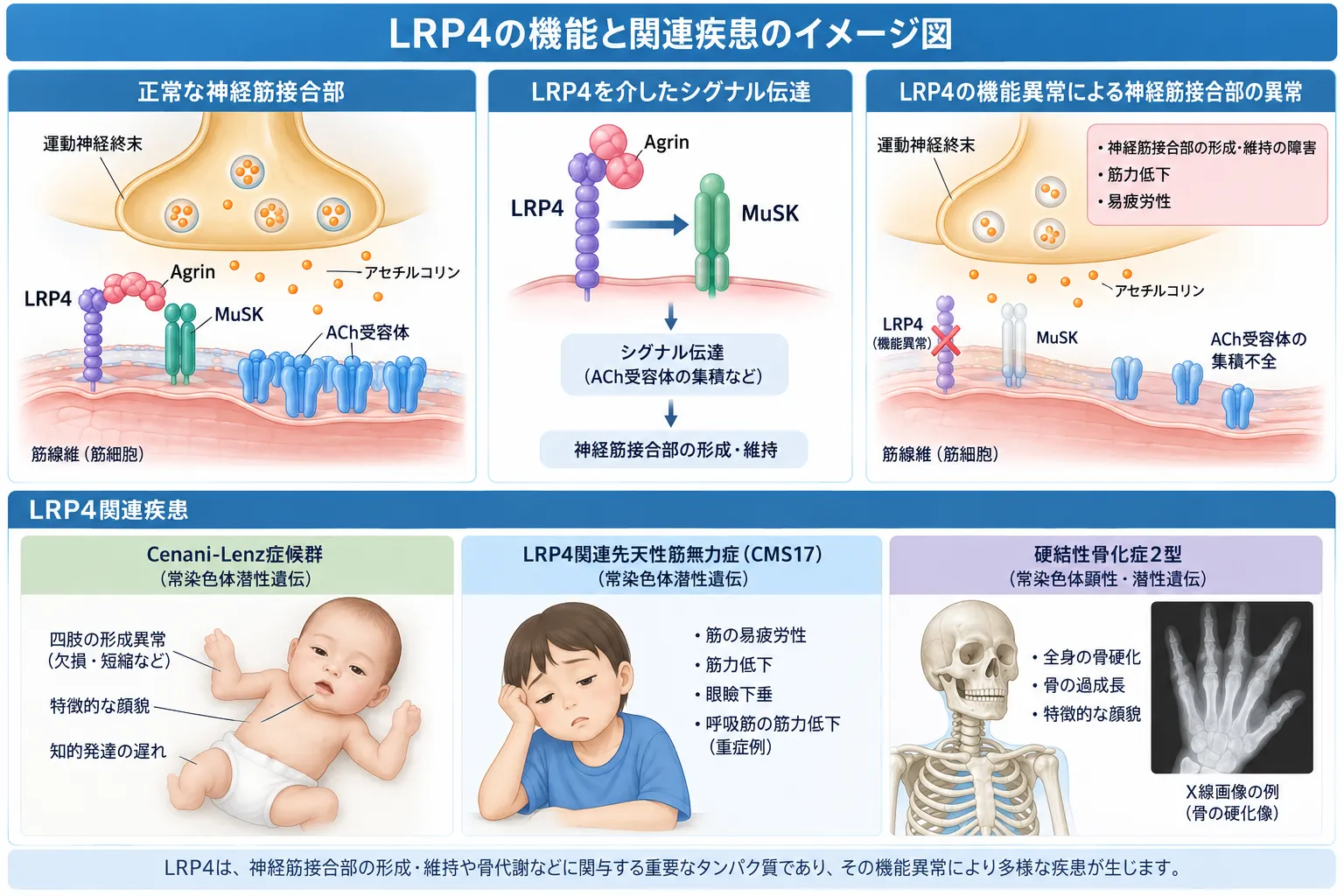 LRP4の機能と関連疾患を示す医学イラスト。神経筋接合部におけるAgrin-LRP4-MuSKシグナルとACh受容体の集積、LRP4機能異常による神経筋接合部障害、Cenani-Lenz症候群、LRP4関連先天性筋無力症候群（CMS17）、硬結性骨化症2型との関連を示す
