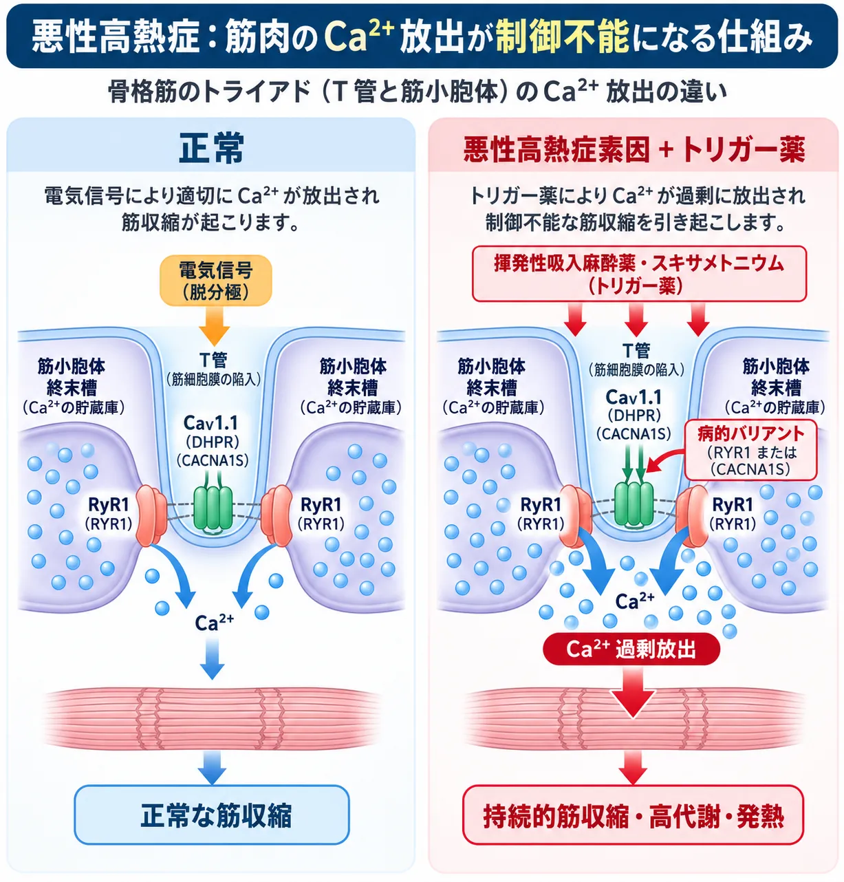 悪性高熱症で、正常な骨格筋ではCaV1.1（CACNA1S）とRyR1（RYR1）が連携してCa²⁺放出を調節する一方、悪性高熱症素因ではトリガー薬によりCa²⁺が過剰放出され、持続的筋収縮・高代謝・発熱に至る仕組みを比較した模式図