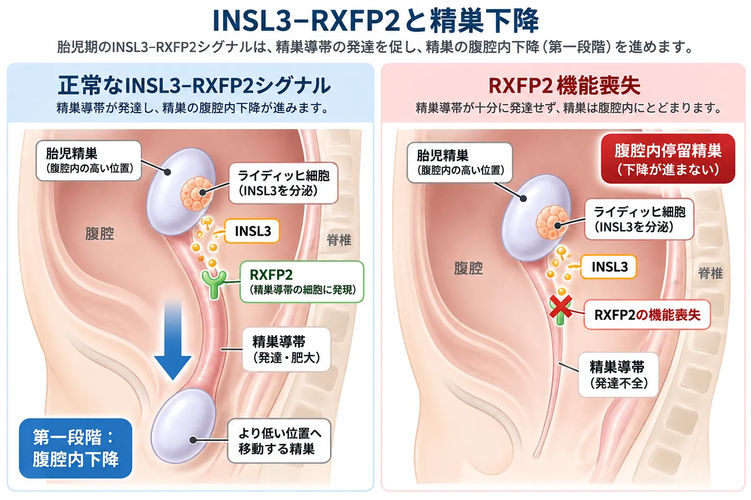 INSL3-RXFP2シグナルによる胎児期の精巣下降とRXFP2機能喪失による停留精巣を比較した模式図。正常ではライディッヒ細胞から分泌されたINSL3が精巣導帯のRXFP2に作用して精巣導帯の発達を促し、精巣の腹腔内下降が進む。RXFP2機能喪失では精巣導帯の発達が不十分となり、精巣が腹腔内に停留する