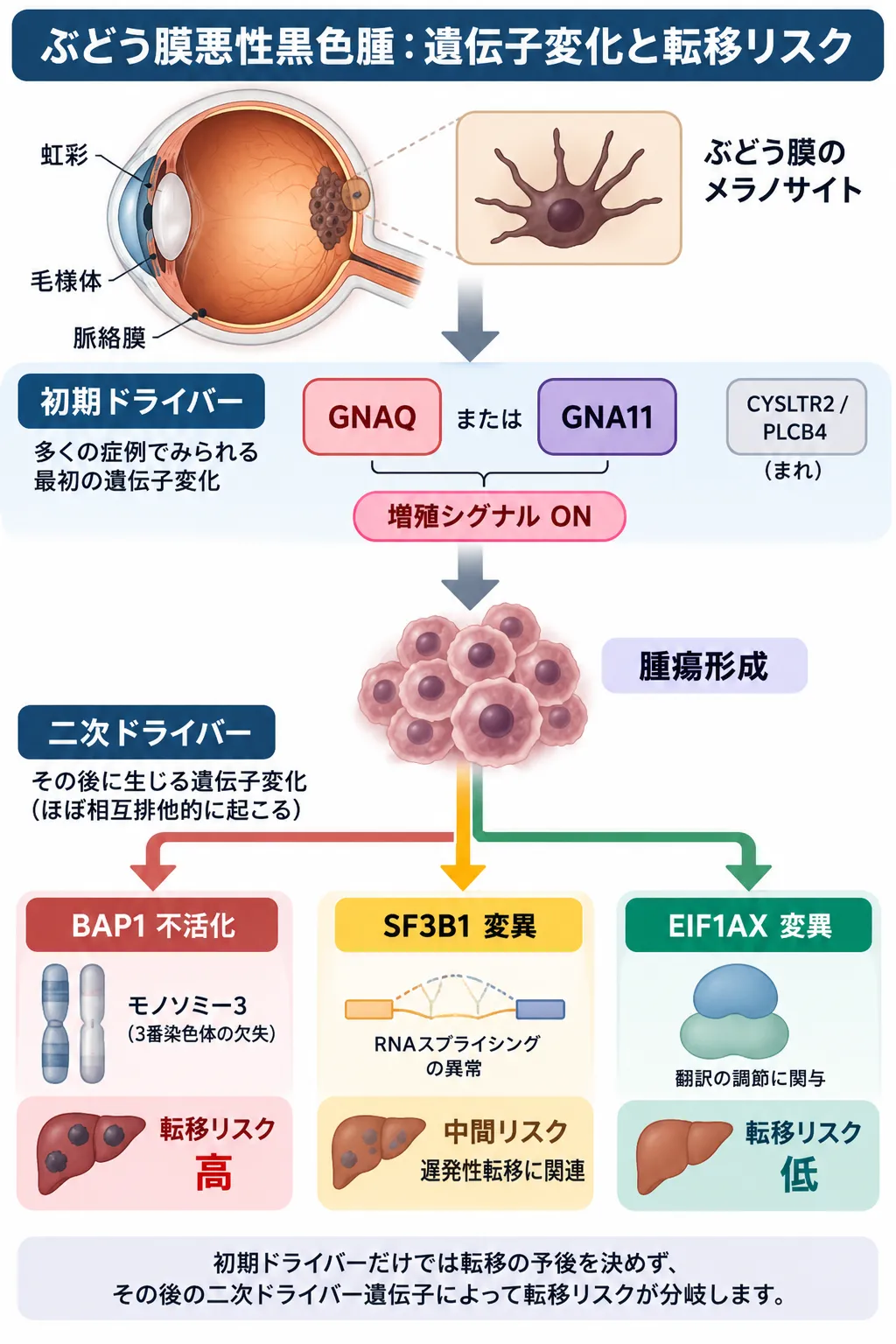 ぶどう膜悪性黒色腫でGNAQ・GNA11などの初期ドライバー変異から腫瘍が形成され、その後BAP1不活化、SF3B1変異、EIF1AX変異によって転移リスクが高・中・低へ分岐する遺伝子進展モデルを示した模式図
