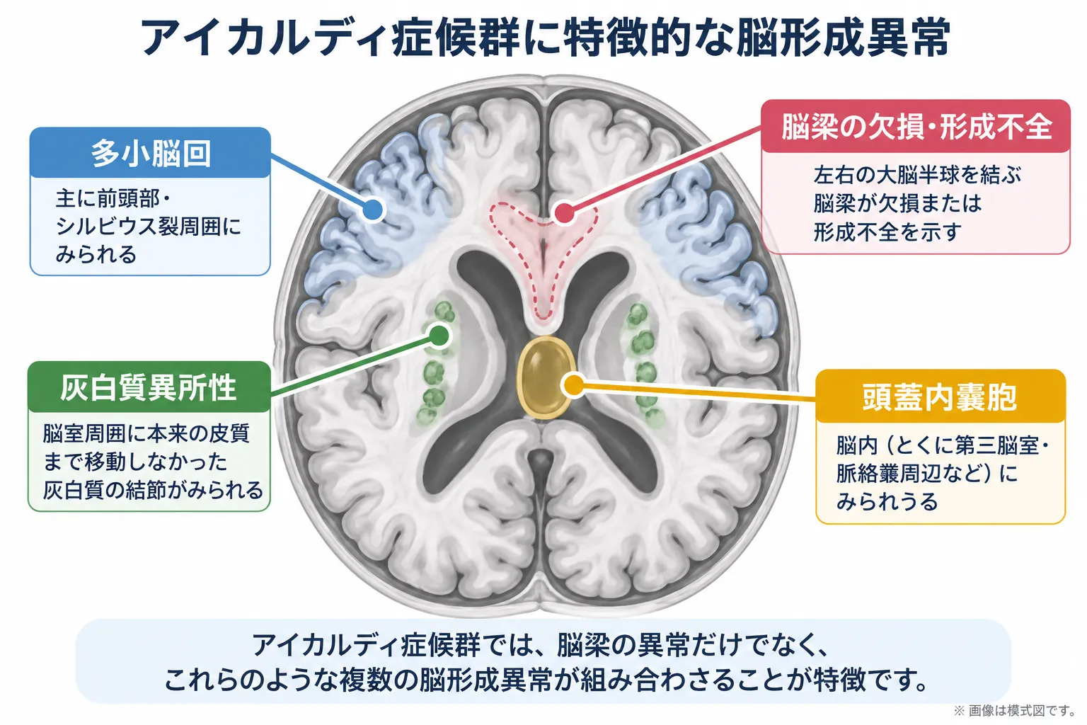 アイカルディ症候群に特徴的な脳形成異常の模式図。脳梁の欠損・形成不全、多小脳回、脳室周囲の灰白質異所性、頭蓋内嚢胞が組み合わさってみられることを示す