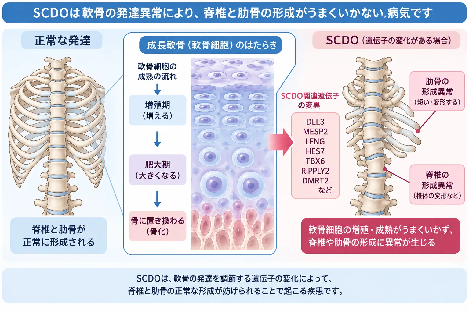 正常な脊椎・肋骨形成と、SCDO関連遺伝子の変化によって椎骨・肋骨の形成異常が生じる状態を比較した模式図
