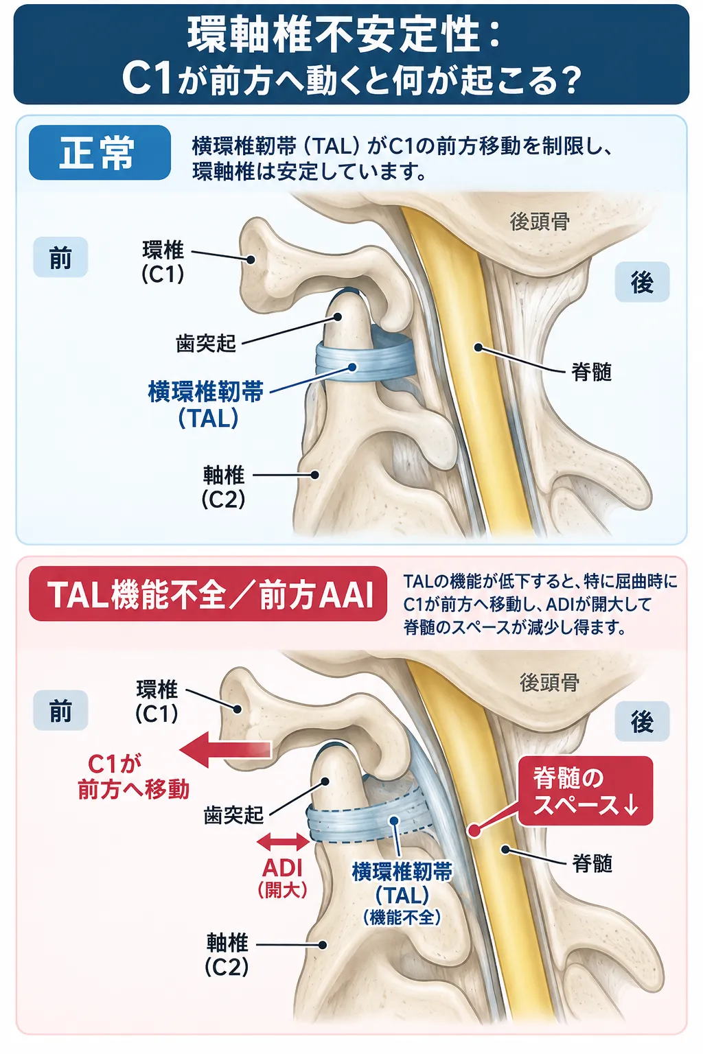 正常では横環椎靱帯（TAL）が環椎C1の前方移動を制限する一方、TAL機能不全ではC1が前方へ移動してADIが開大し、脊髄のスペースが減少する環軸椎不安定性（AAI）の仕組みを比較した模式図