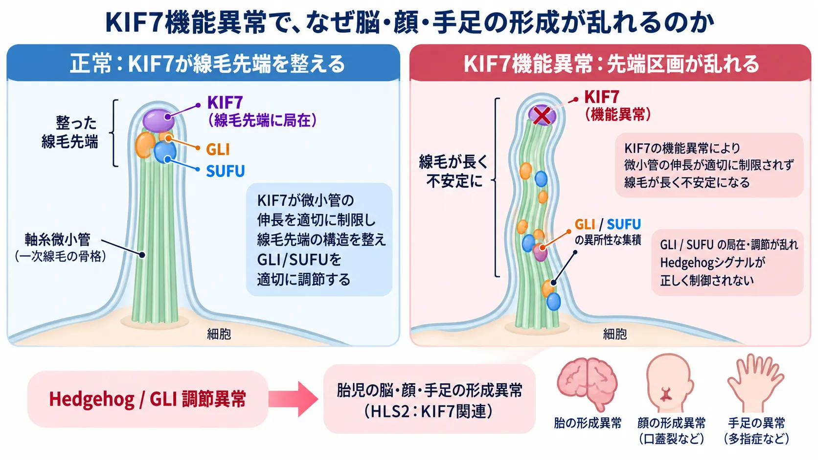 KIF7が一次線毛先端の微小管伸長とGLI・SUFUの局在を調節する正常状態と、KIF7機能異常により線毛先端構造とHedgehog・GLIシグナル制御が乱れ、胎児の脳・顔・手足の形成異常につながる仕組みを比較した模式図