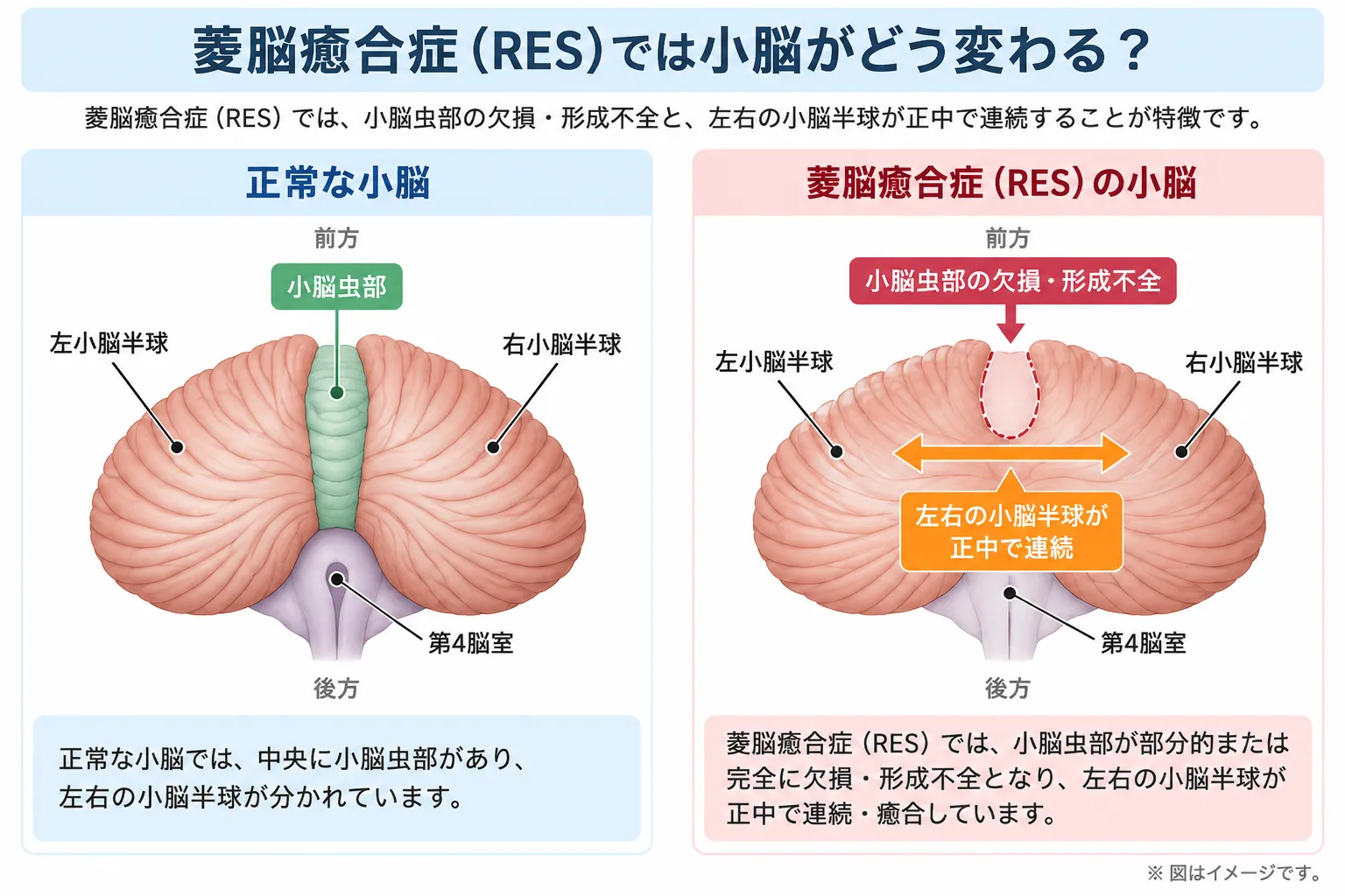 正常な小脳と菱脳癒合症（RES）を比較し、正常では小脳虫部によって左右の小脳半球が分かれるのに対し、RESでは小脳虫部が欠損・形成不全となり左右の小脳半球が正中で連続・癒合する構造を示した模式図