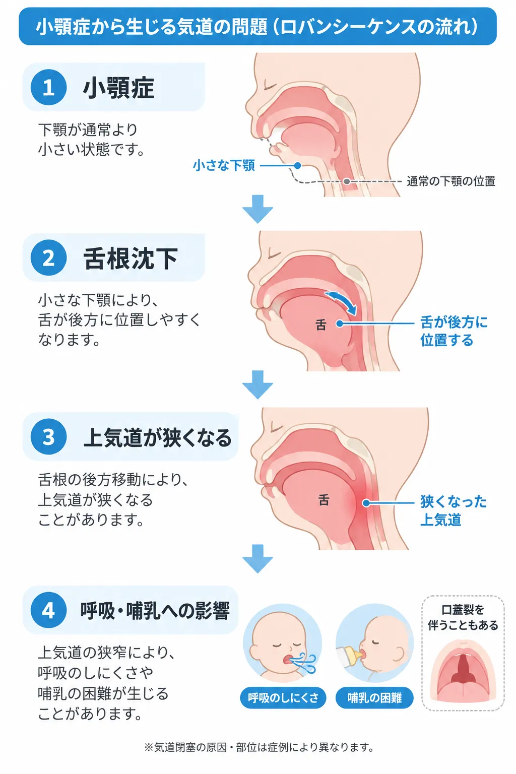 小顎症から舌根沈下と上気道狭窄が生じ、呼吸や哺乳に影響するロバンシーケンスの流れを示す模式図。小さい下顎によって舌が後方に位置しやすくなり、上気道が狭くなる過程と、呼吸困難・哺乳困難、口蓋裂を伴うことがあることを示す。