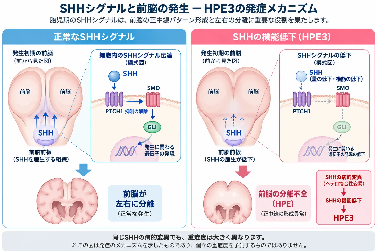 正常ではSHHシグナルがPTCH1・SMO・GLIを介して前脳の正中線形成と左右分離を促す一方、HPE3ではSHH機能低下によりシグナルが低下し、前脳の分離不全につながる発症機序を比較した模式図