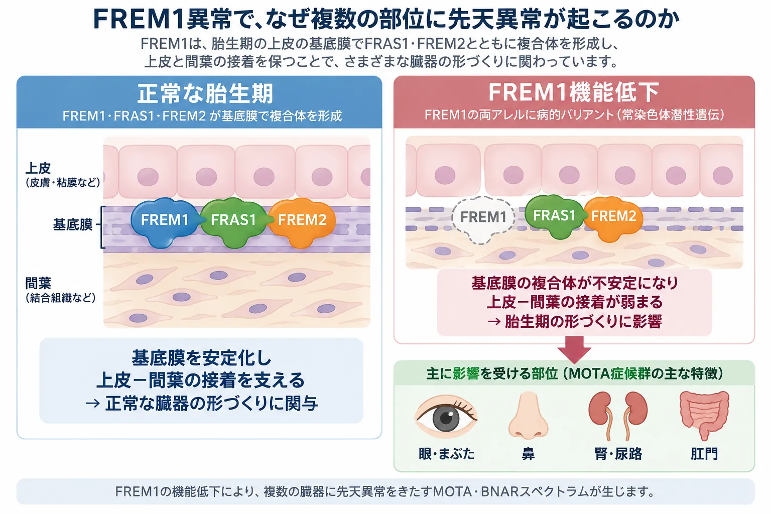 FREM1が基底膜でFRAS1・FREM2と複合体を形成して上皮と間葉の接着を支える正常な胎生期と、FREM1機能低下により基底膜が不安定化し、眼・まぶた、鼻、腎・尿路、肛門などの先天異常につながる仕組みを比較した模式図