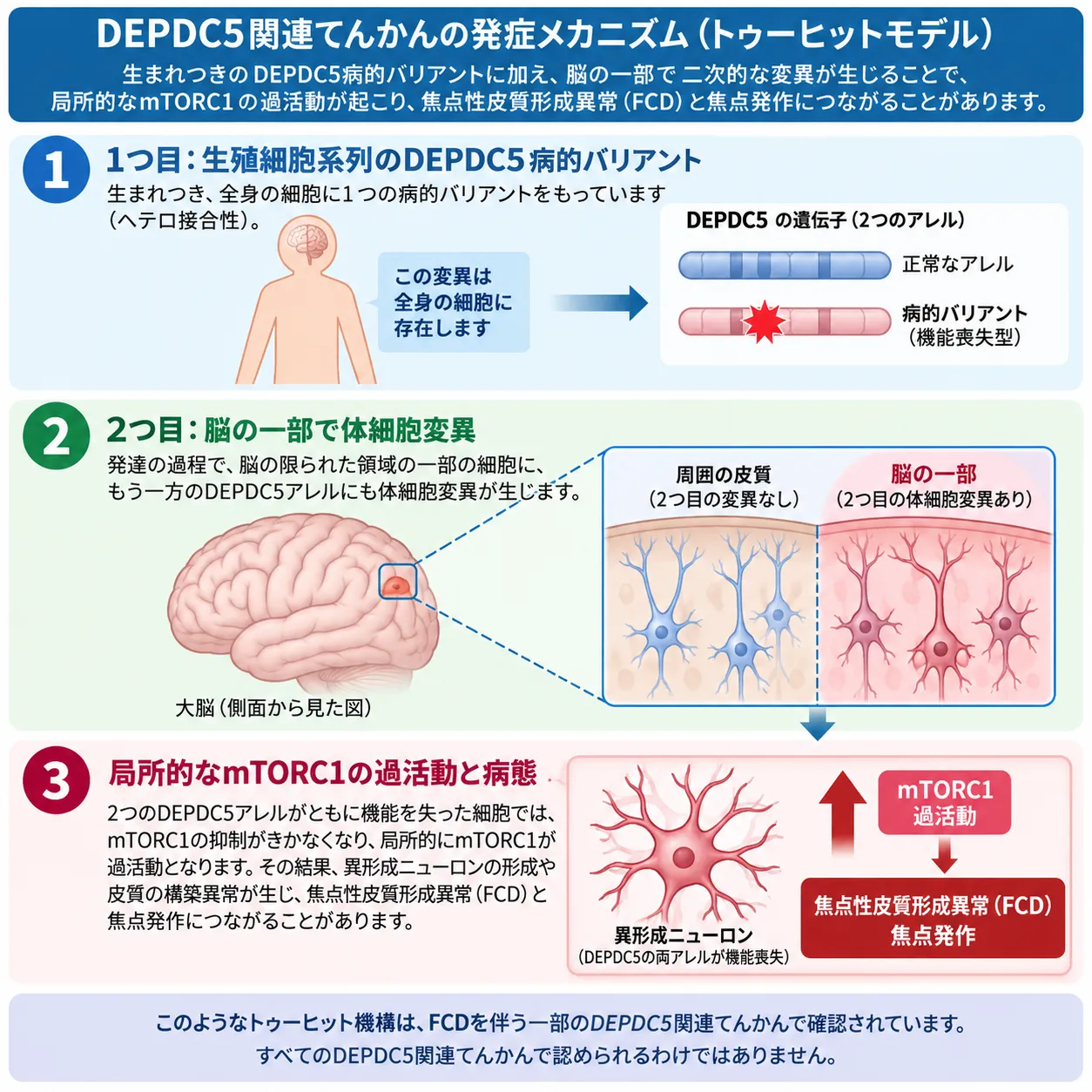 DEPDC5関連てんかんの発症メカニズム|トゥーヒットモデルとmTORC1過活動 DEPDC5関連てんかんにおいて、生殖細胞系列のDEPDC5病的バリアントに脳の一部で生じた体細胞変異が重なり、局所的なmTORC1過活動から焦点性皮質形成異常(FCD)と焦点発作につながるトゥーヒットモデルの模式図
