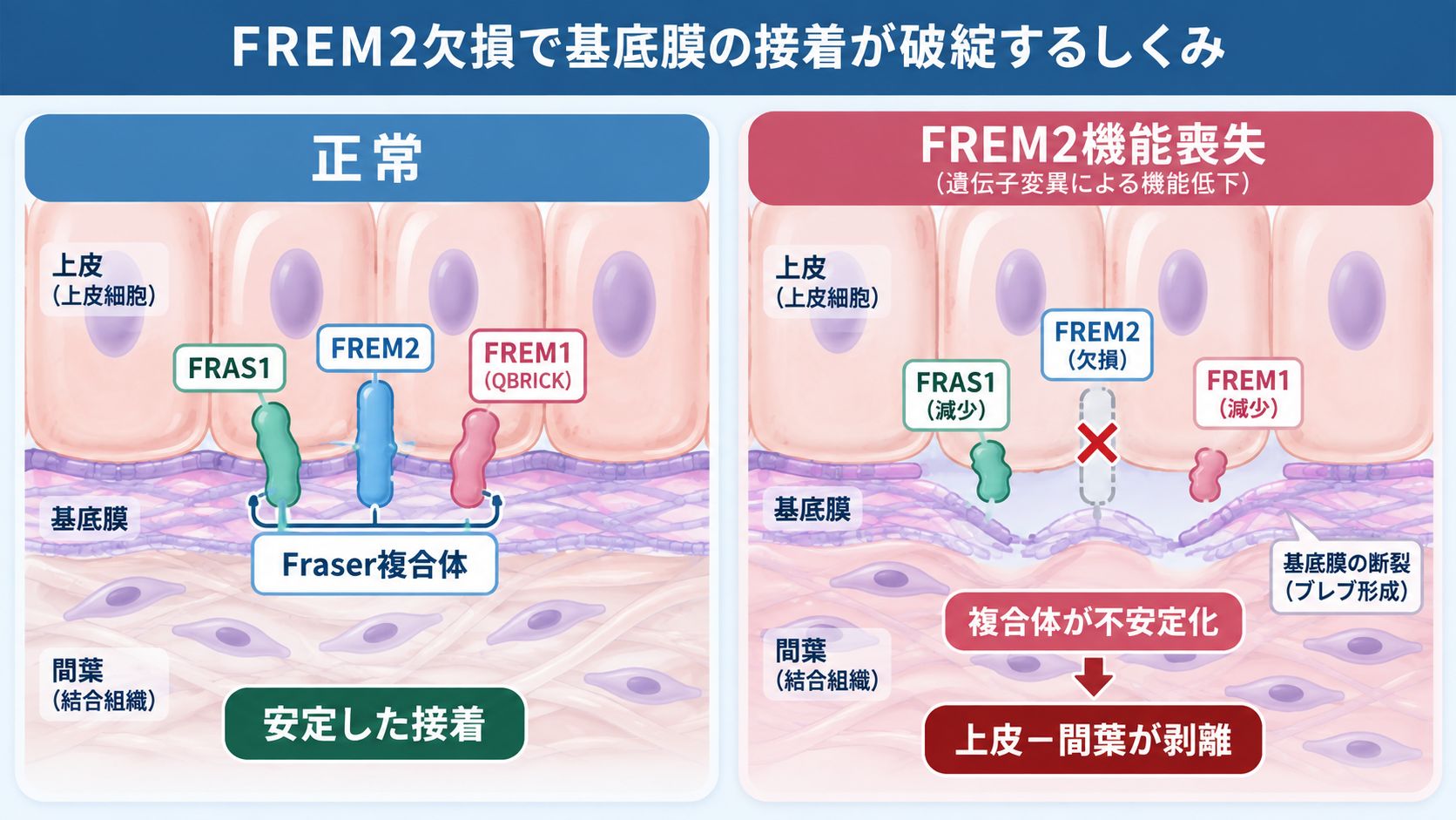 正常ではFREM2・FRAS1・FREM1が基底膜でFraser複合体を形成して上皮と間葉の接着を支える一方、FREM2機能喪失では複合体が不安定化し、基底膜の破綻と上皮・間葉の剥離につながる仕組みを比較した模式図