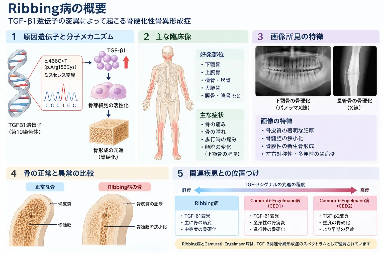 Ribbing病における長管骨の骨幹部硬化・骨皮質肥厚・髄腔狭窄、TGFB1遺伝子変異とCamurati–Engelmann病との関連を示す医学イラスト