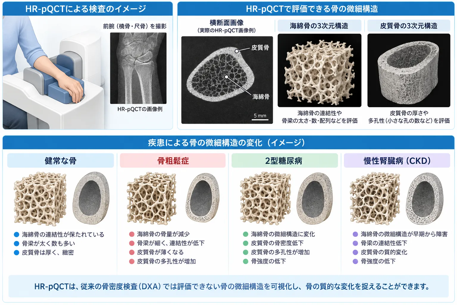 HR-pQCTによる手首の撮影方法と、皮質骨・海綿骨の三次元微細構造、骨粗鬆症・2型糖尿病・慢性腎臓病における骨構造の変化を示す医学イラスト