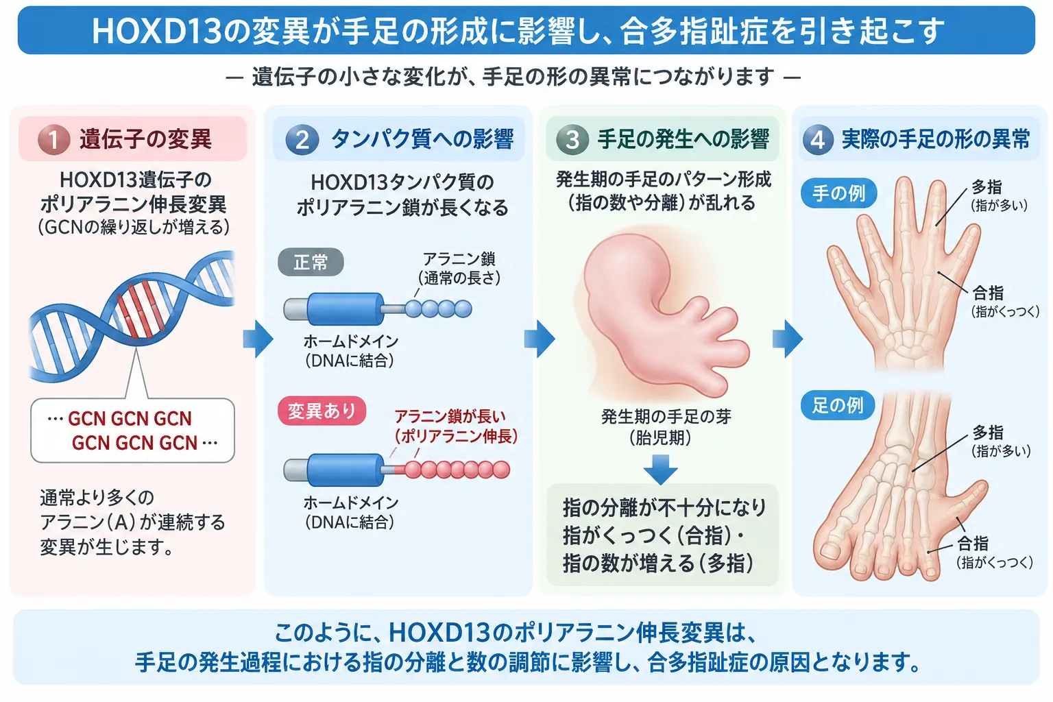 HOXD13ポリアラニン伸長変異による合多指趾症の発症機序 HOXD13遺伝子のポリアラニン伸長変異によりHOXD13タンパク質の機能が変化し、胎児期の手足のパターン形成が乱れて合指と多指を伴う合多指趾症につながる仕組みを示す模式図