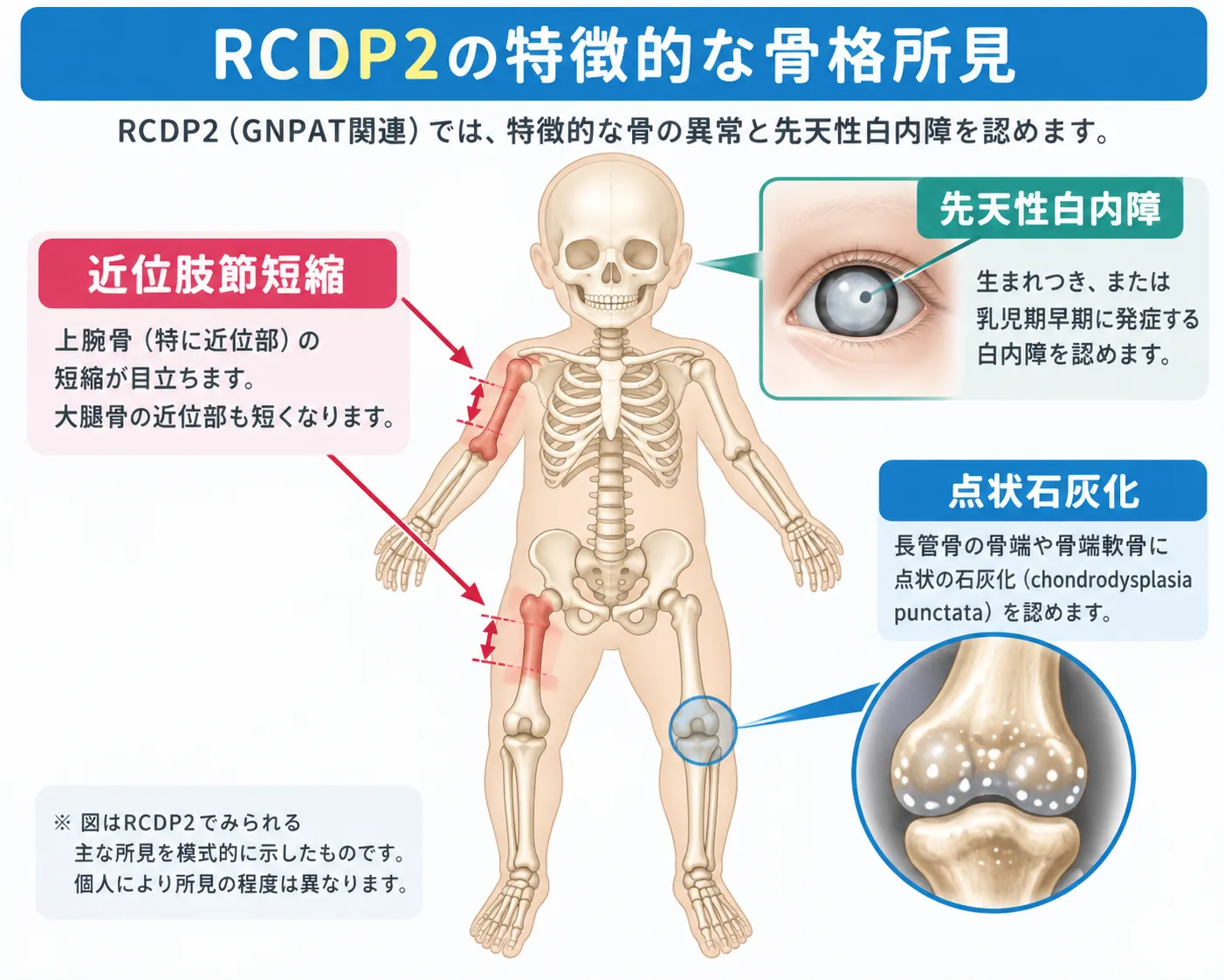 RCDP2の特徴的な骨格所見と先天性白内障 RCDP2でみられる上腕骨・大腿骨の近位肢節短縮、長管骨骨端軟骨の点状石灰化、先天性白内障の位置と特徴を示した医学模式図
