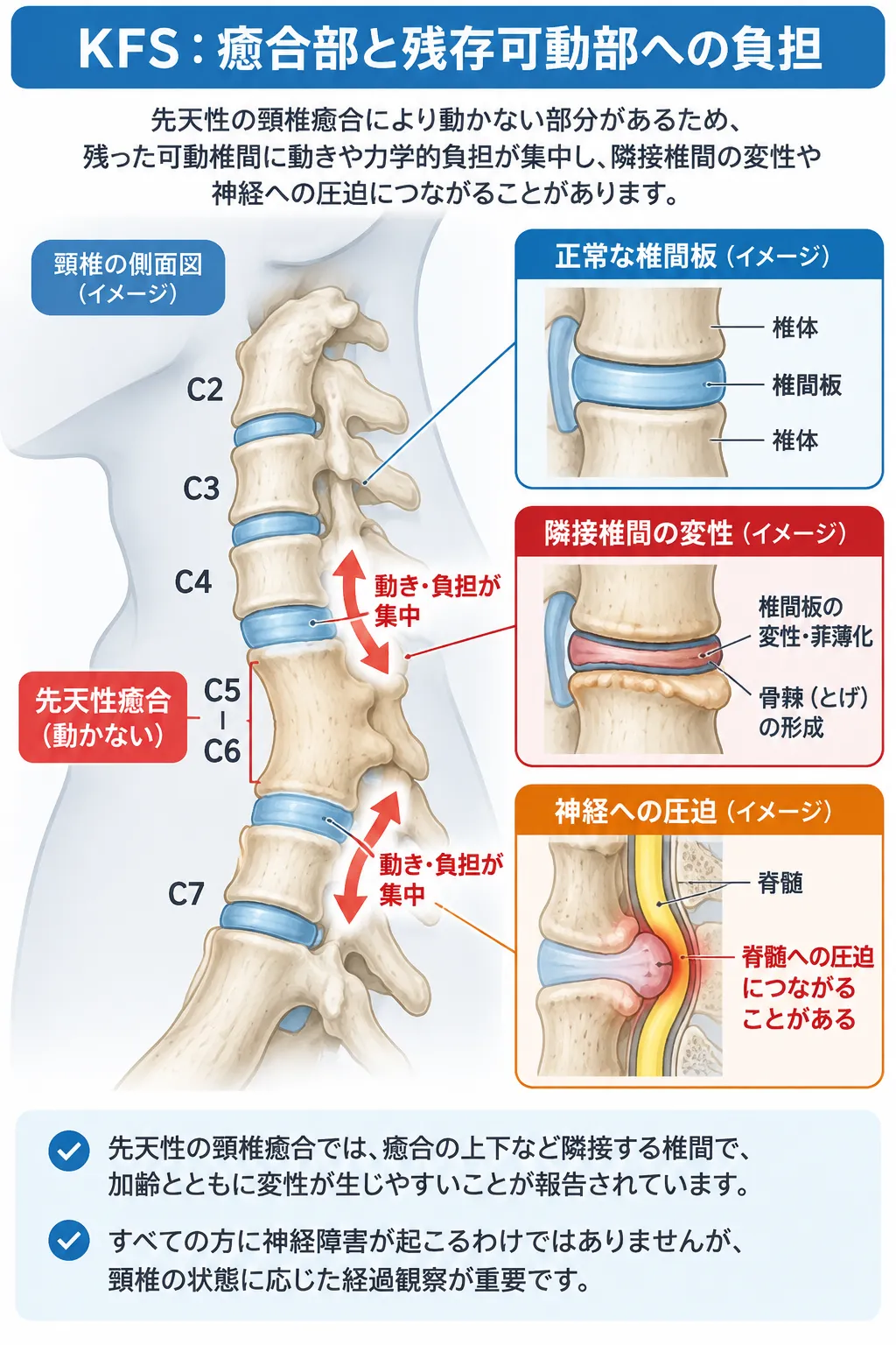 クリッペル・ファイル症候群(KFS)で先天性頸椎癒合により残存可動椎間へ力学的負担が集中し、隣接椎間板の変性や脊髄圧迫につながる仕組みを示す模式図
