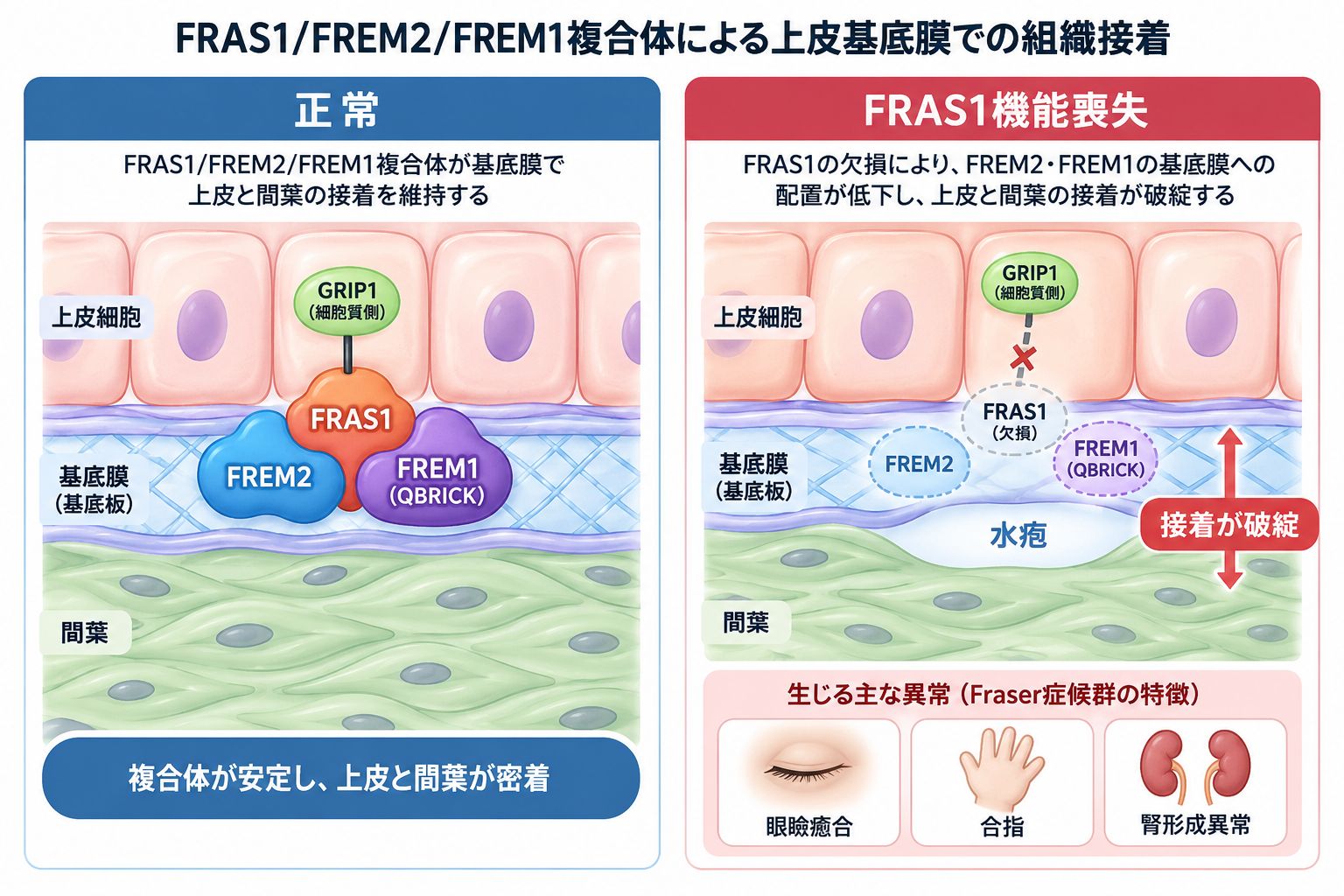 FRAS1・FREM2・FREM1複合体が胎児期の基底膜で上皮と間葉の接着を支える正常状態と、FRAS1機能喪失により複合体の配置が低下し、組織接着の破綻から器官形成異常につながる仕組みを比較した模式図