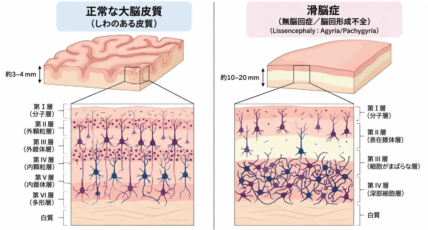 正常な大脳皮質と無脳回・厚脳回（滑脳症）の皮質構造を比較した模式図。左の正常皮質は多数の脳回（しわ）を持ち厚さ3〜4mm、神経細胞が整然と並ぶ6層構造（第I層分子層から第VI層多形細胞層まで）を示す。右の滑脳症皮質は脳表が平滑で厚さ10〜20mm、6層構造が失われ、第I層分子層・第II層表在錐体細胞層・第III層細胞希薄層・第IV層深部細胞層からなる異常な4層構造に再編成され、深部に神経細胞が乱雑に密集している。