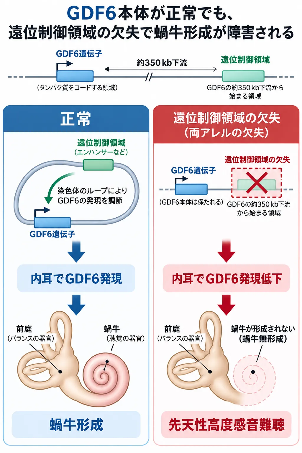GDF6遺伝子本体が正常でも、約350kb下流の遠位制御領域が両アレルで欠失すると内耳でGDF6発現が低下し、蝸牛無形成と先天性高度感音難聴につながる仕組みを正常例と比較した模式図
