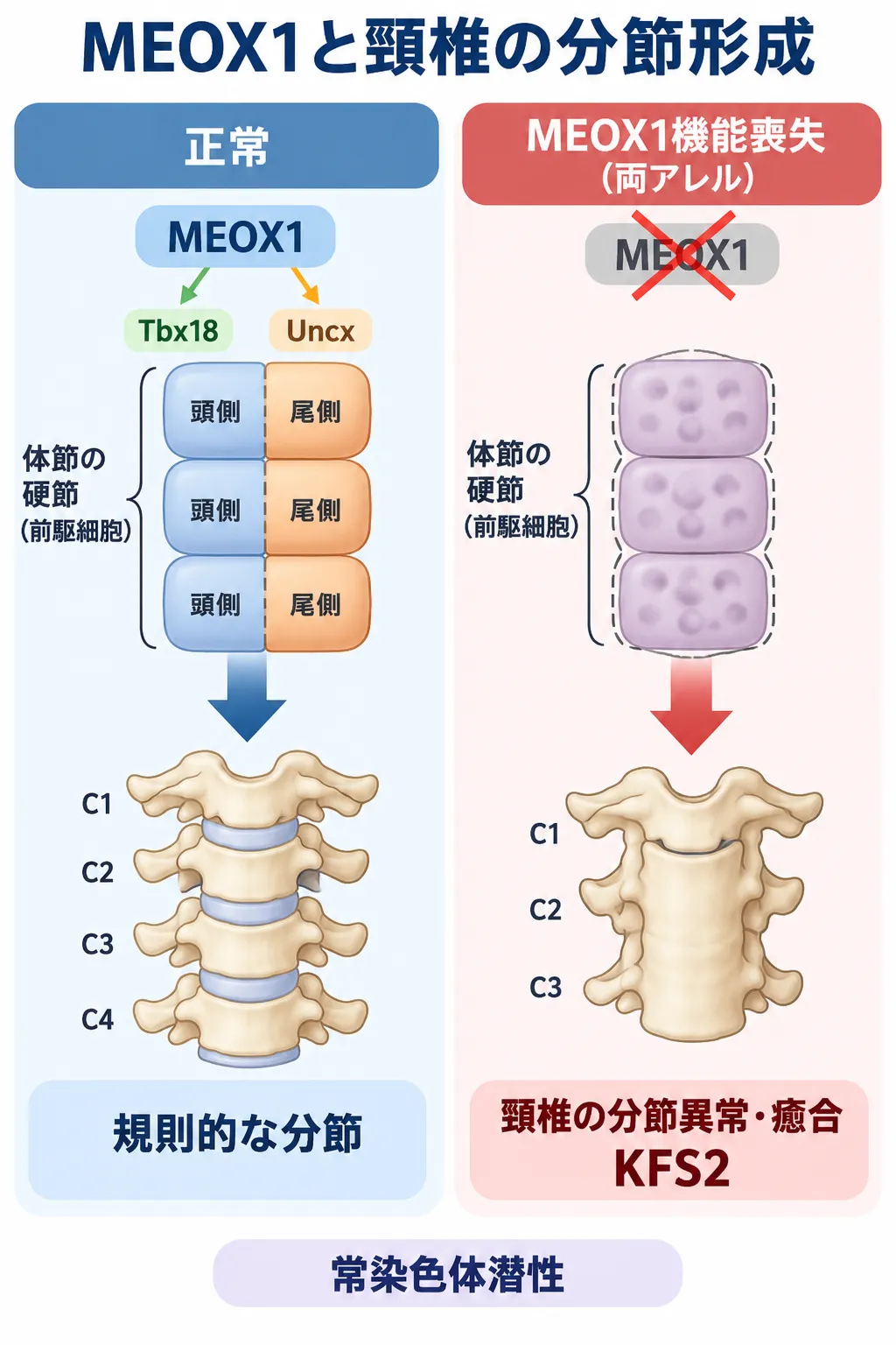 MEOX1が正常に働く場合の硬節の頭側・尾側の規則的な分節と、両アレルのMEOX1機能喪失によって硬節の分節が乱れ、頸椎の分節異常・癒合を伴うクリッペル・ファイル症候群2型（KFS2）に至る仕組みを比較した模式図
