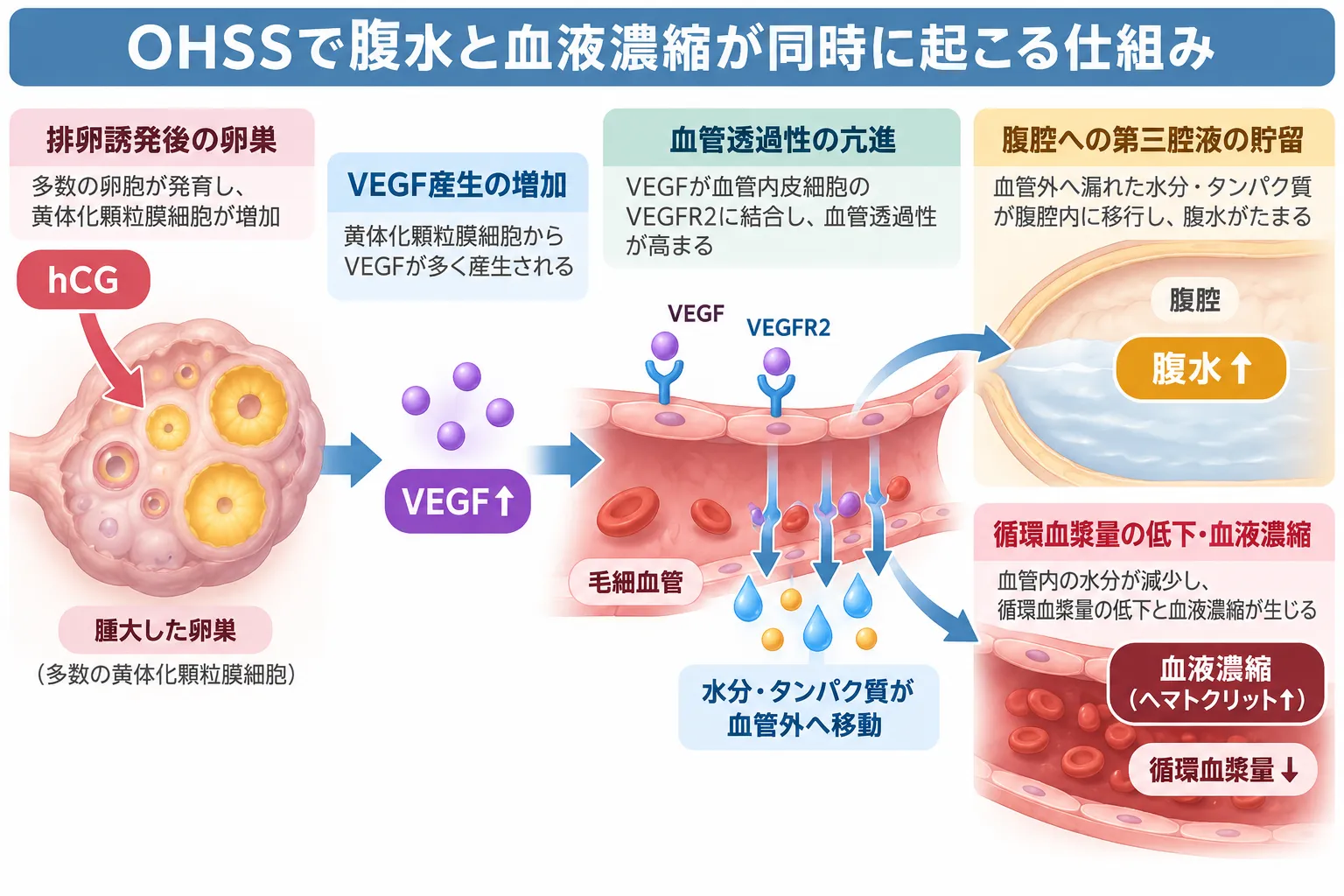 OHSSでhCG刺激により卵巣のVEGF産生が増加し、VEGFR2を介した血管透過性亢進によって水分とタンパク質が血管外へ漏れ、腹水と血液濃縮が同時に生じる仕組みを示した模式図